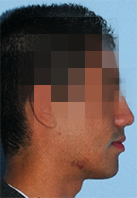 implantes dentales